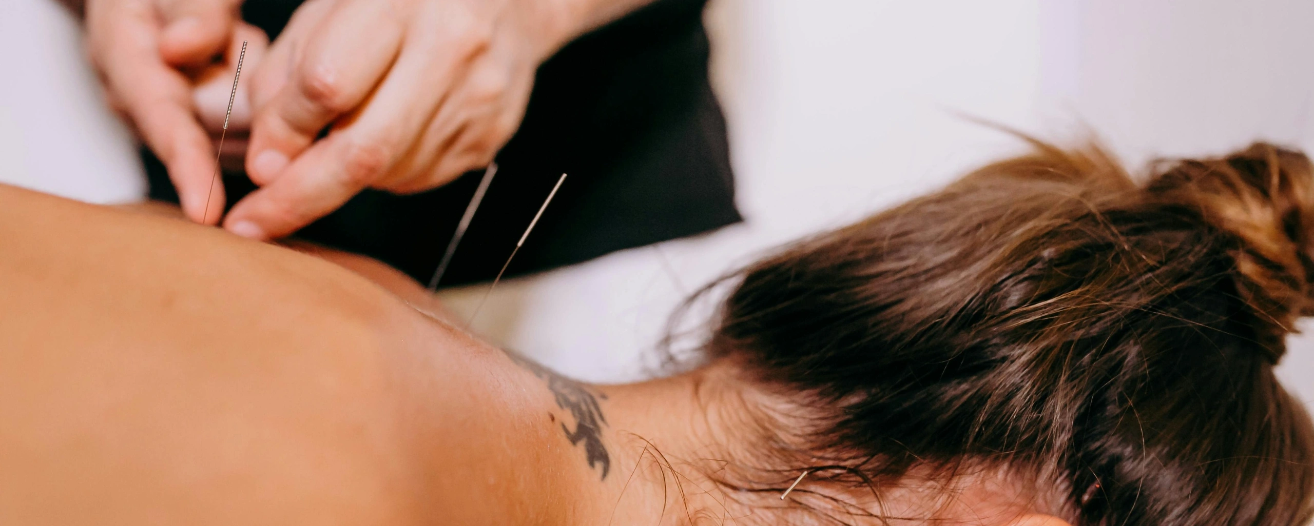 Dry Needling